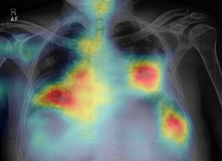 Covid: pubblicato studio Gaslini e Galliera su farmaco anti infiammazione polmonare