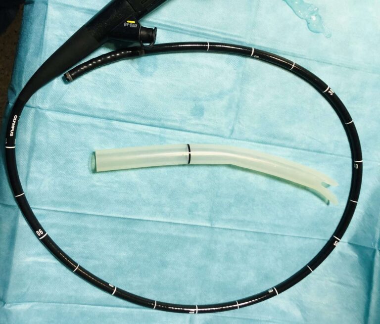 Al Galliera intervento meno invasivo per i diverticoli nell’esofago