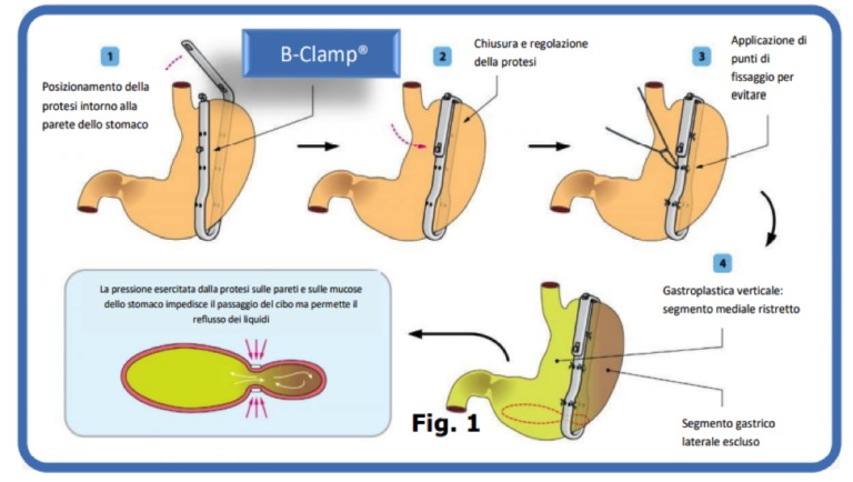 Obesità: all’Iclas di Rapallo il primo intervento in Liguria di gastroplastica verticale