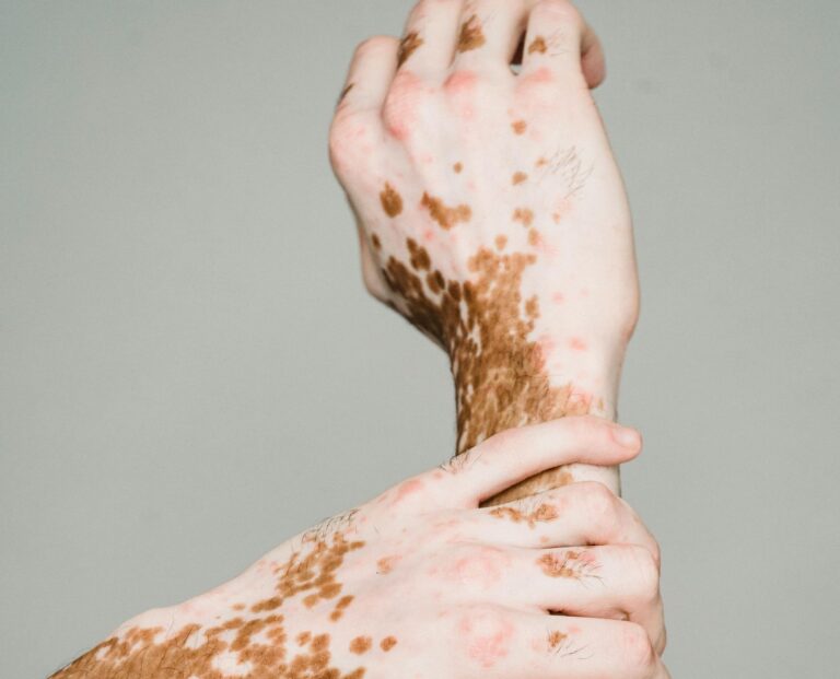 Vitiligine Week, dal 25 al 30 novembre si può prenotare una visita al San Martino